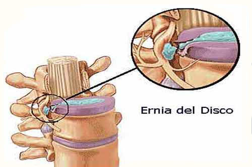 Ernia e mal di schiena: istruzioni per l’uso